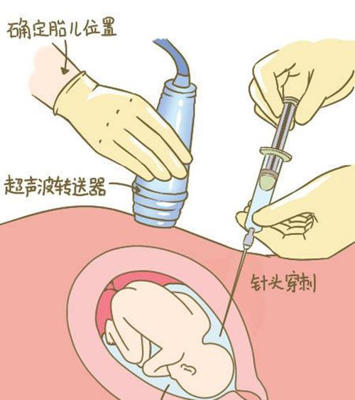 丽水羊水孕期亲子鉴定
